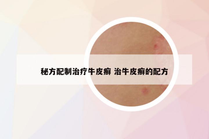 秘方配制治疗牛皮癣 治牛皮癣的配方