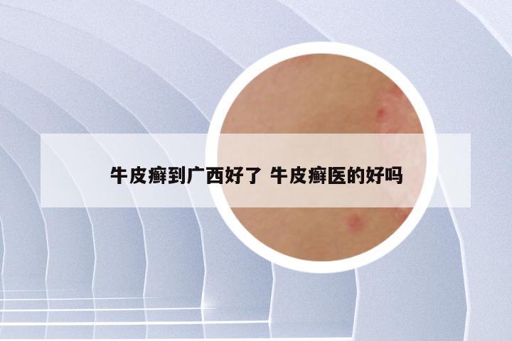 牛皮癣到广西好了 牛皮癣医的好吗
