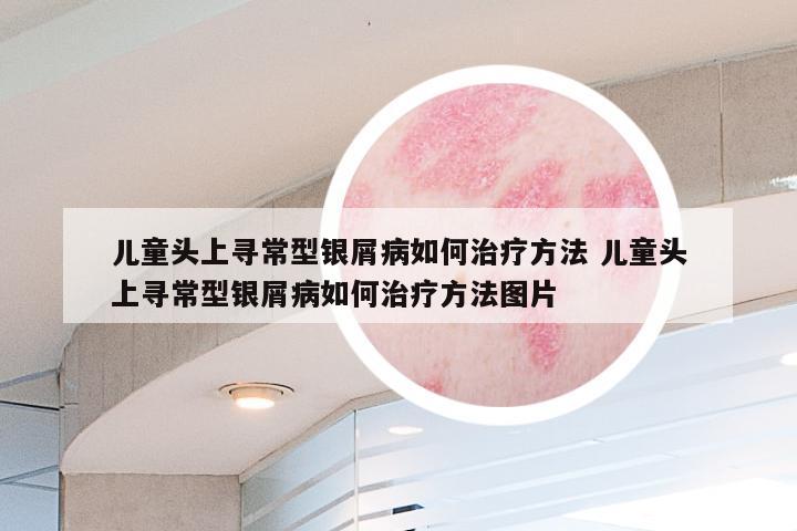 儿童头上寻常型银屑病如何治疗方法 儿童头上寻常型银屑病如何治疗方法图片