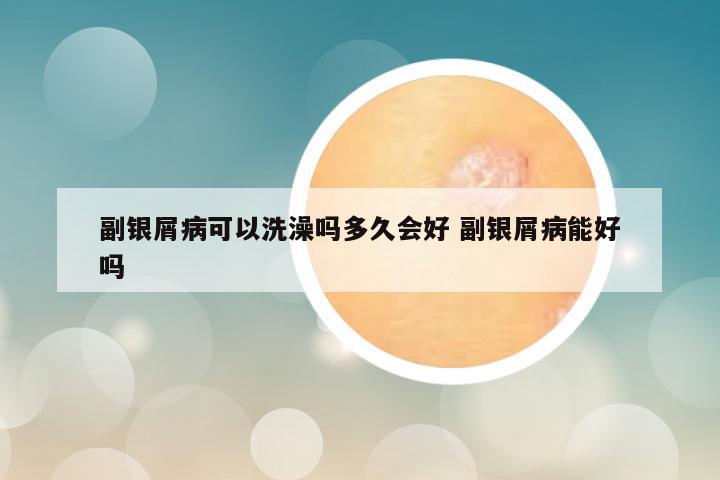 副银屑病可以洗澡吗多久会好 副银屑病能好吗