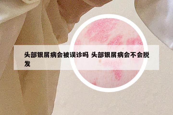 头部银屑病会被误诊吗 头部银屑病会不会脱发