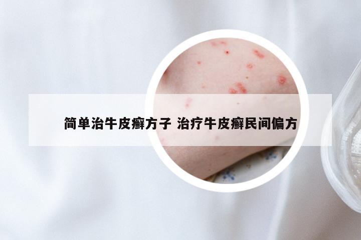 简单治牛皮癣方子 治疗牛皮癣民间偏方