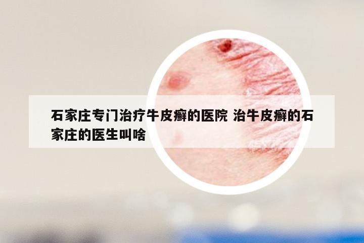 石家庄专门治疗牛皮癣的医院 治牛皮癣的石家庄的医生叫啥