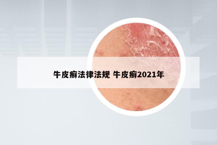 牛皮癣法律法规 牛皮癣2021年