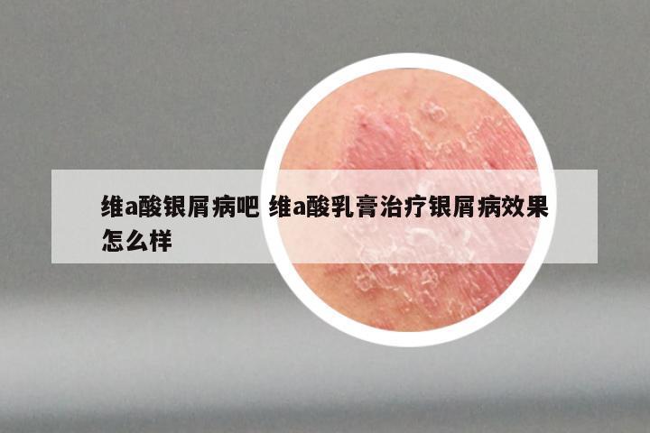 维a酸银屑病吧 维a酸乳膏治疗银屑病效果怎么样
