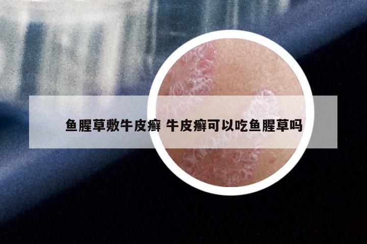 鱼腥草敷牛皮癣 牛皮癣可以吃鱼腥草吗