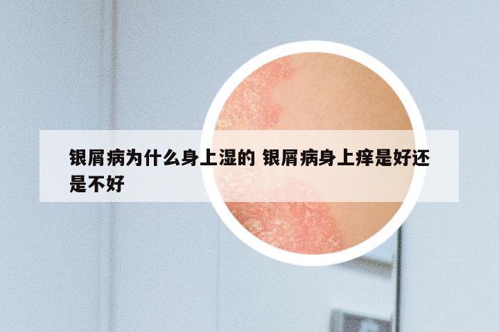 银屑病为什么身上湿的 银屑病身上痒是好还是不好