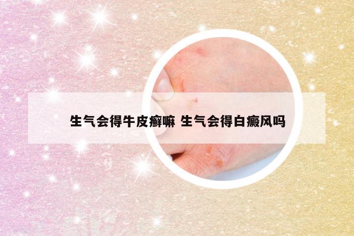 生气会得牛皮癣嘛 生气会得白癜风吗
