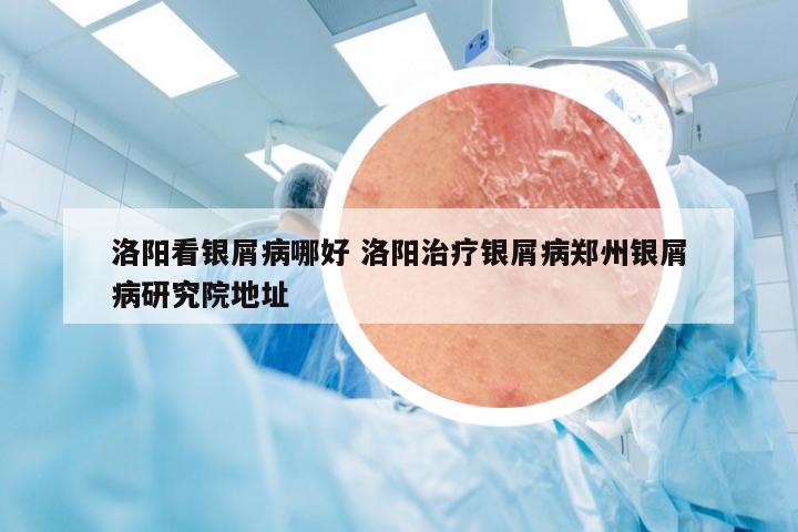 洛阳看银屑病哪好 洛阳治疗银屑病郑州银屑病研究院地址