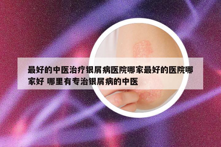 最好的中医治疗银屑病医院哪家最好的医院哪家好 哪里有专治银屑病的中医