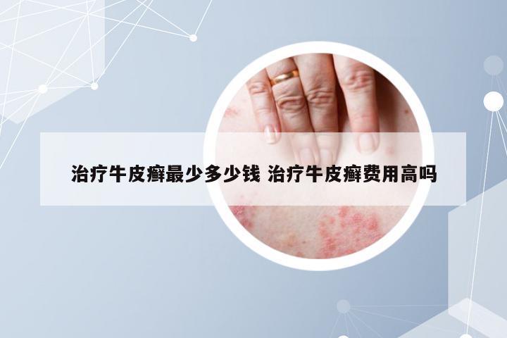 治疗牛皮癣最少多少钱 治疗牛皮癣费用高吗
