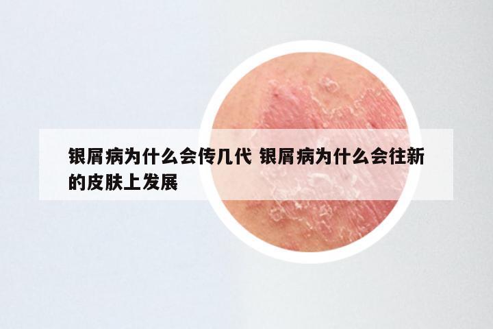 银屑病为什么会传几代 银屑病为什么会往新的皮肤上发展