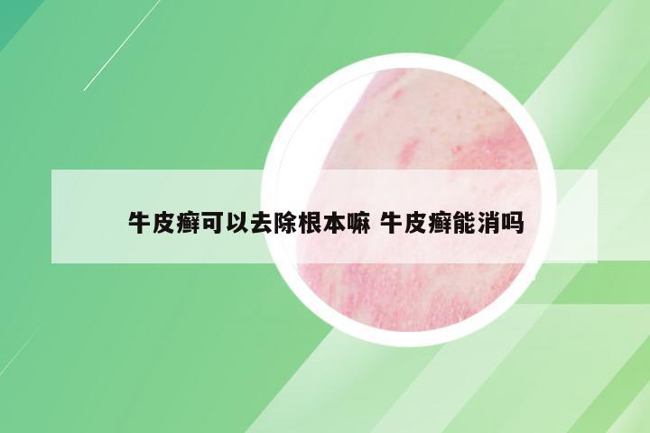 牛皮癣可以去除根本嘛 牛皮癣能消吗