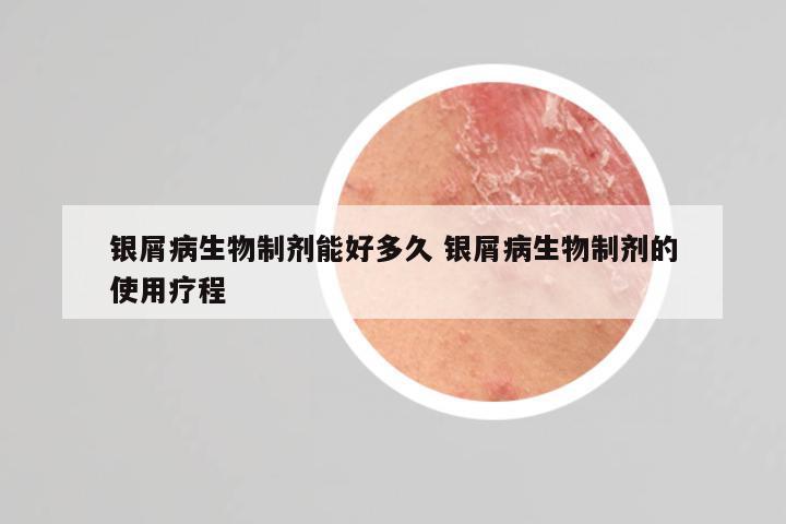 银屑病生物制剂能好多久 银屑病生物制剂的使用疗程