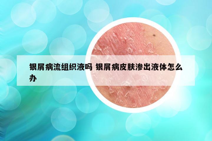 银屑病流组织液吗 银屑病皮肤渗出液体怎么办