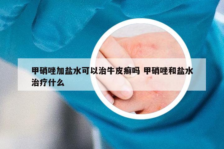 甲硝唑加盐水可以治牛皮癣吗 甲硝唑和盐水治疗什么