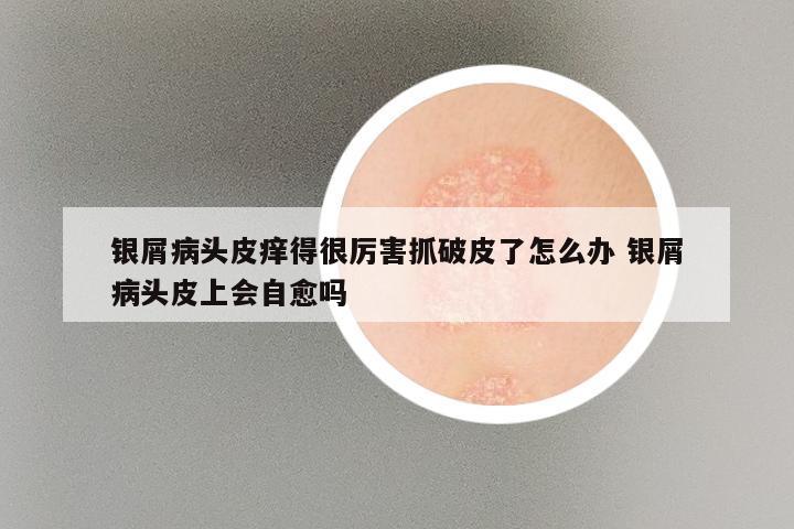 银屑病头皮痒得很厉害抓破皮了怎么办 银屑病头皮上会自愈吗