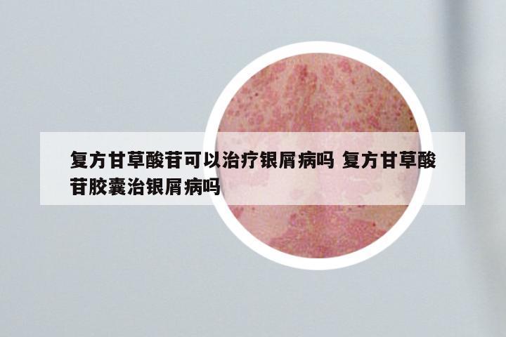 复方甘草酸苷可以治疗银屑病吗 复方甘草酸苷胶囊治银屑病吗
