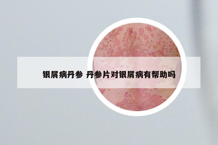 银屑病丹参 丹参片对银屑病有帮助吗