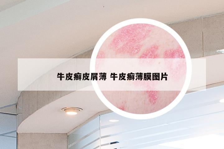 牛皮癣皮屑薄 牛皮癣薄膜图片