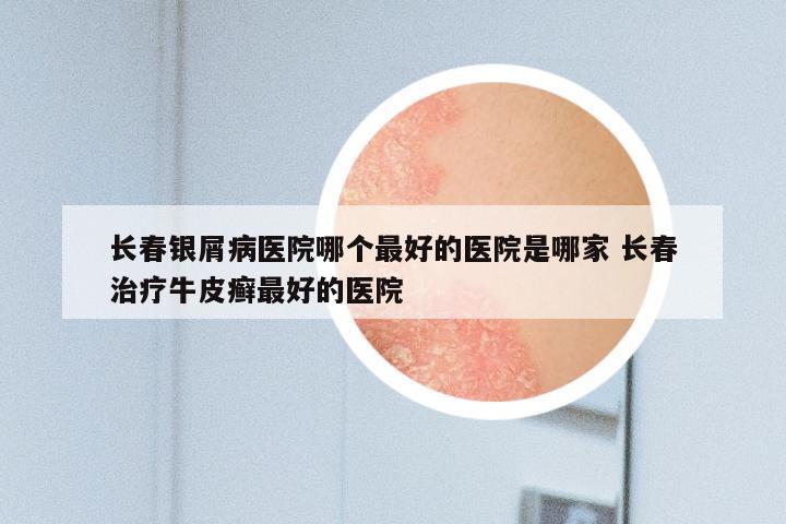 长春银屑病医院哪个最好的医院是哪家 长春治疗牛皮癣最好的医院