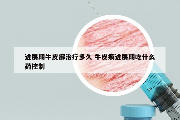 进展期牛皮癣治疗多久 牛皮癣进展期吃什么药控制