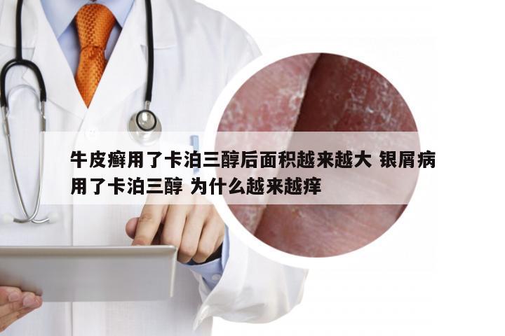 牛皮癣用了卡泊三醇后面积越来越大 银屑病用了卡泊三醇 为什么越来越痒