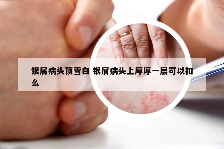 银屑病头顶雪白 银屑病头上厚厚一层可以扣么