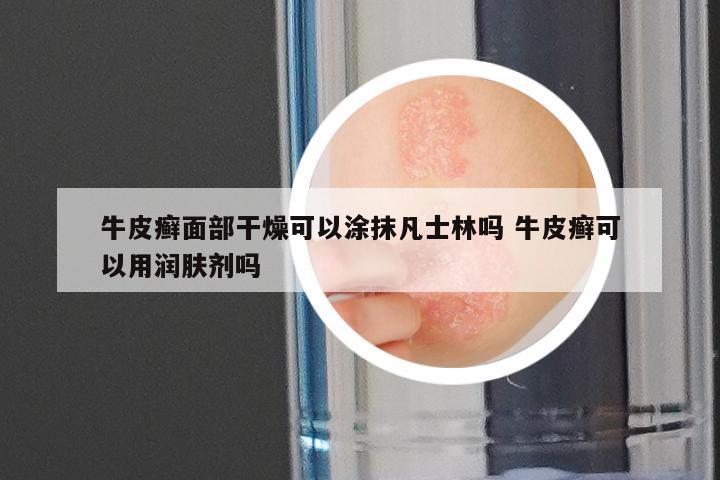 牛皮癣面部干燥可以涂抹凡士林吗 牛皮癣可以用润肤剂吗
