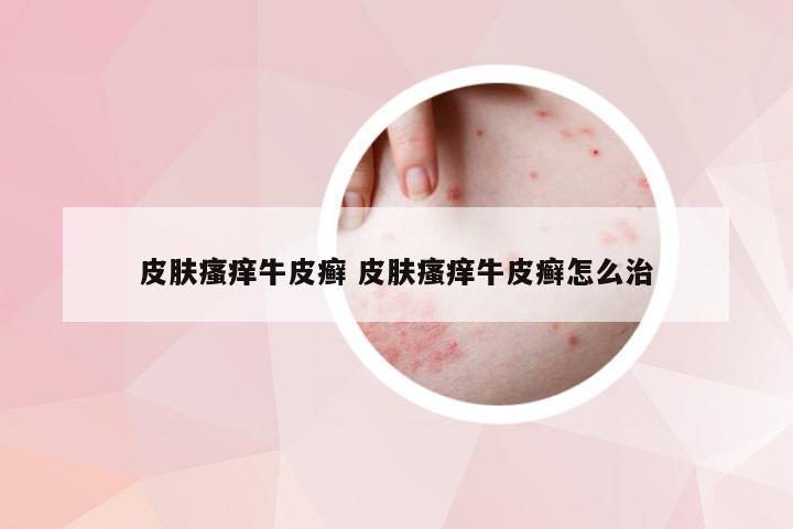 皮肤瘙痒牛皮癣 皮肤瘙痒牛皮癣怎么治