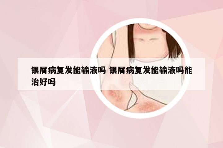 银屑病复发能输液吗 银屑病复发能输液吗能治好吗
