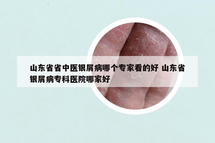山东省省中医银屑病哪个专家看的好 山东省银屑病专科医院哪家好
