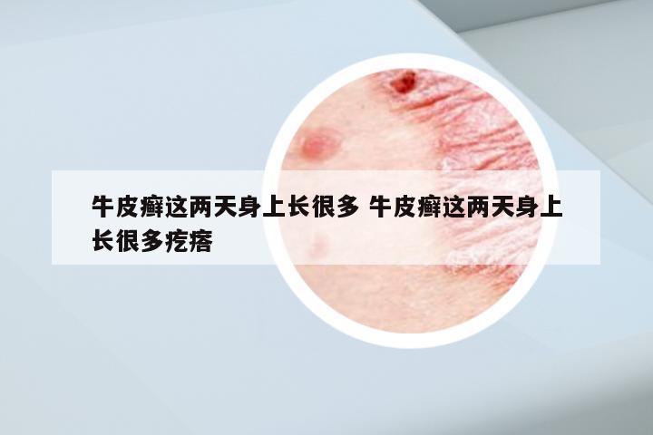 牛皮癣这两天身上长很多 牛皮癣这两天身上长很多疙瘩