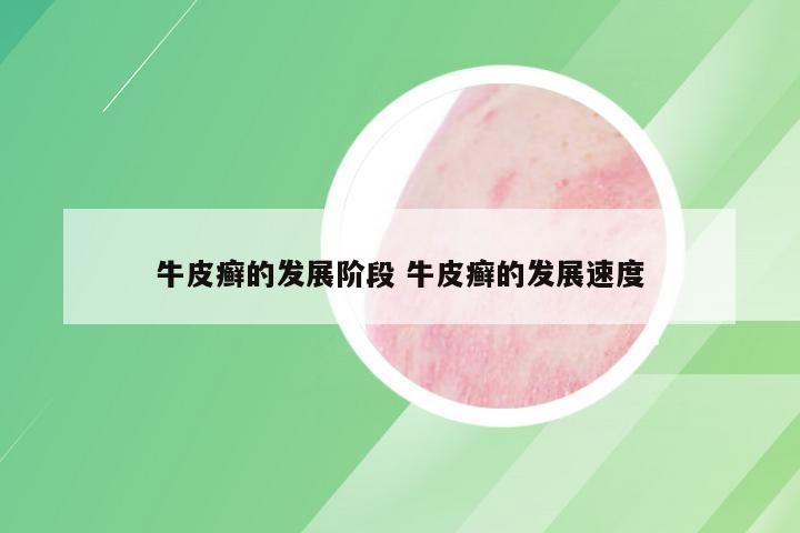 牛皮癣的发展阶段 牛皮癣的发展速度