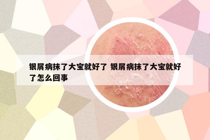 银屑病抹了大宝就好了 银屑病抹了大宝就好了怎么回事