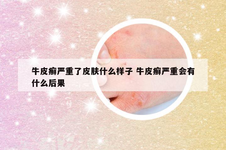 牛皮癣严重了皮肤什么样子 牛皮癣严重会有什么后果