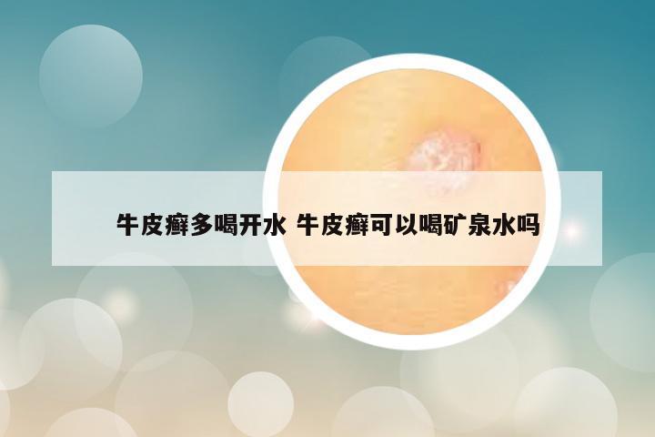 牛皮癣多喝开水 牛皮癣可以喝矿泉水吗