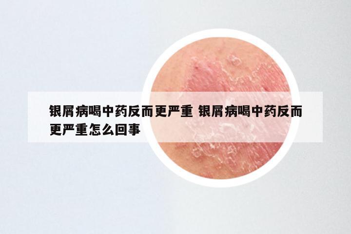 银屑病喝中药反而更严重 银屑病喝中药反而更严重怎么回事