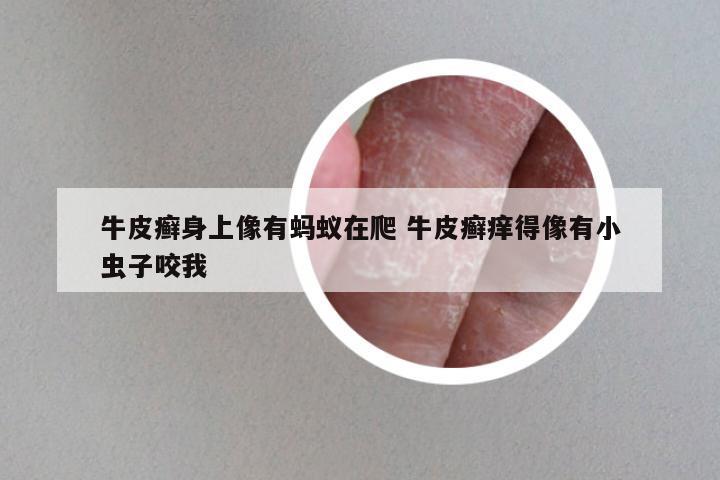 牛皮癣身上像有蚂蚁在爬 牛皮癣痒得像有小虫子咬我