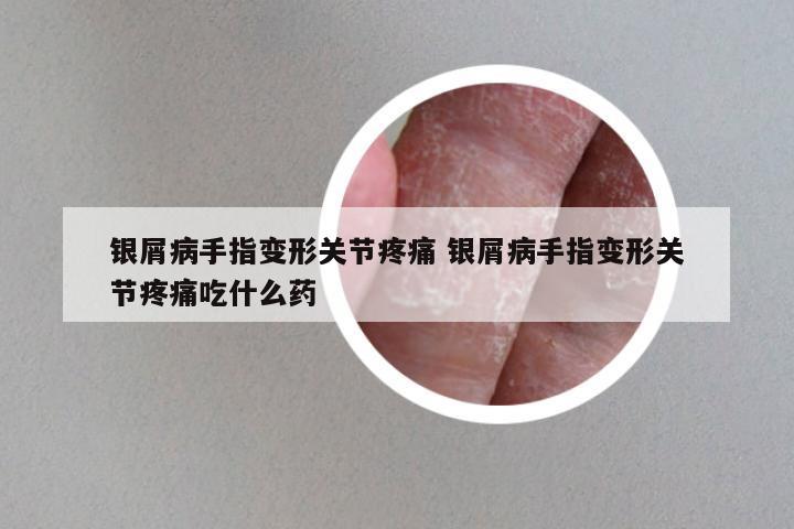 银屑病手指变形关节疼痛 银屑病手指变形关节疼痛吃什么药