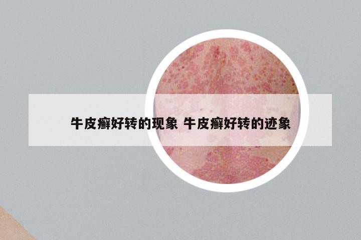 牛皮癣好转的现象 牛皮癣好转的迹象
