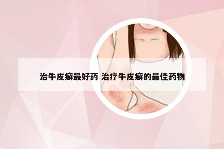 治牛皮癣最好药 治疗牛皮癣的最佳药物