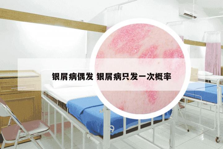 银屑病偶发 银屑病只发一次概率