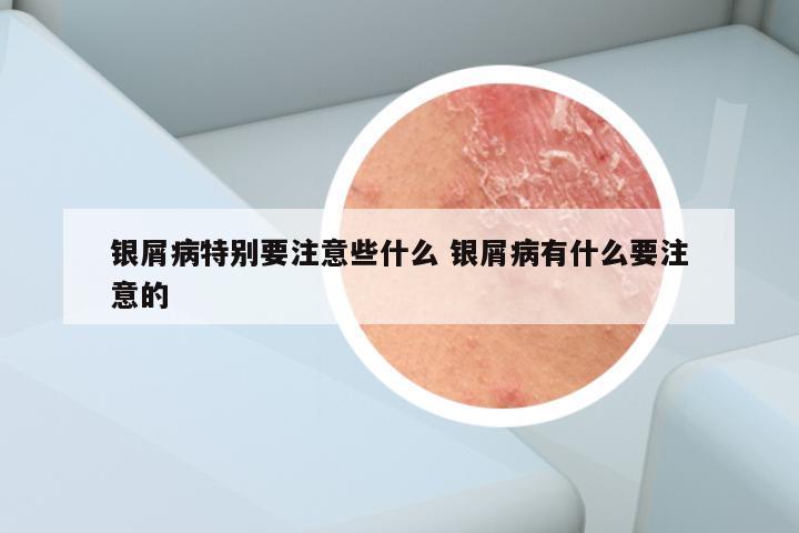 银屑病特别要注意些什么 银屑病有什么要注意的