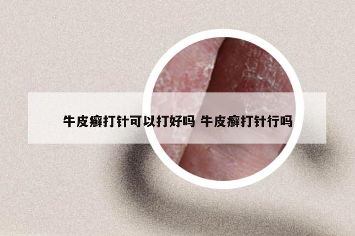 牛皮癣打针可以打好吗 牛皮癣打针行吗