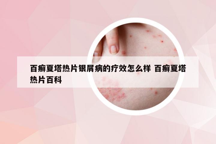 百癣夏塔热片银屑病的疗效怎么样 百癣夏塔热片百科