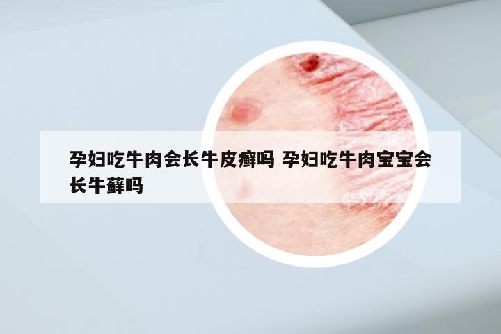 孕妇吃牛肉会长牛皮癣吗 孕妇吃牛肉宝宝会长牛藓吗