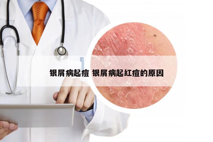 银屑病起痘 银屑病起红痘的原因