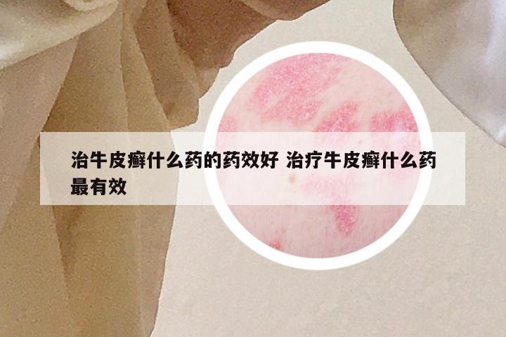 治牛皮癣什么药的药效好 治疗牛皮癣什么药最有效
