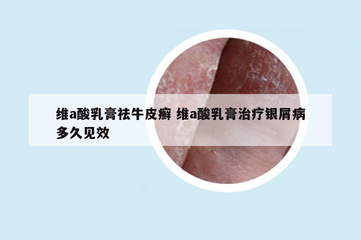维a酸乳膏祛牛皮癣 维a酸乳膏治疗银屑病多久见效